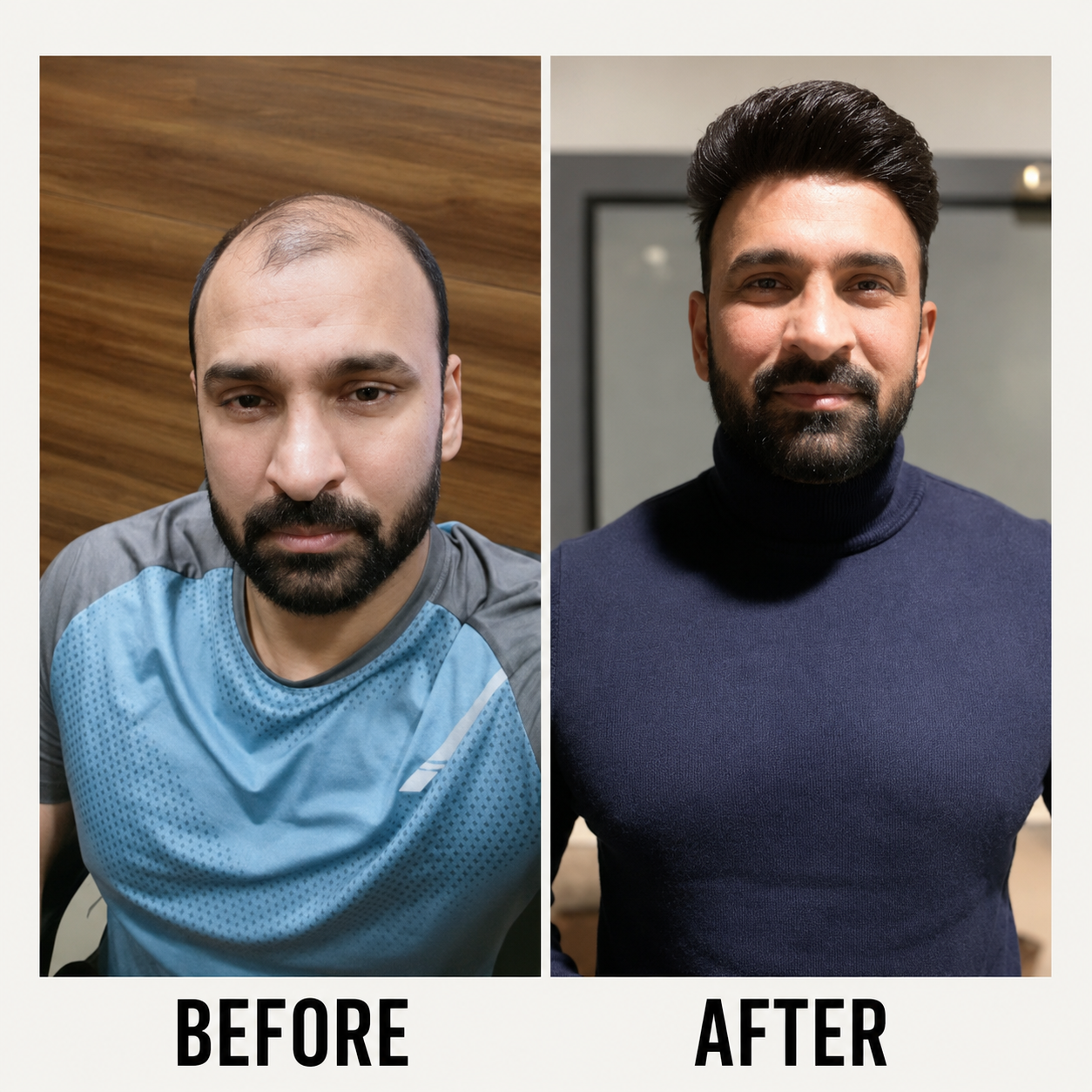 Hair transformation before and after — Indira Hair Weaving Centre, Chandigarh